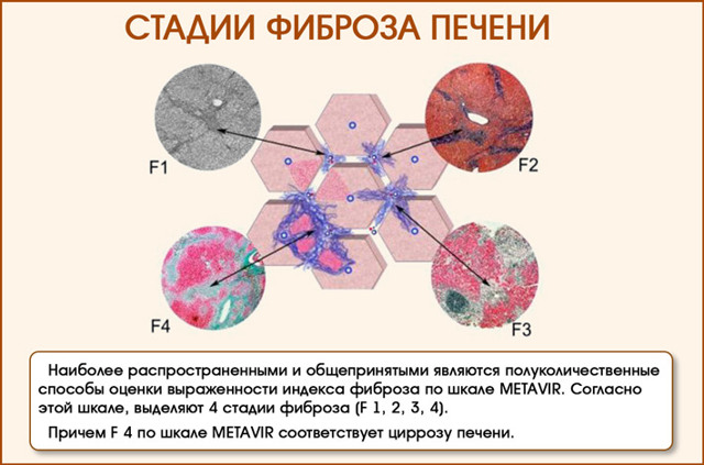 Что такое Фиброз печени 1, 2, 3, 4 степени. Симптомы, прогноз, лечение